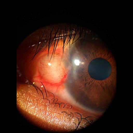 Tumores De Conjuntiva Oncolog A Ocular