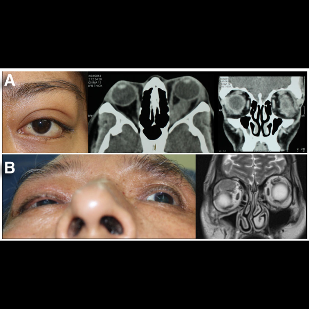 Tumores Orbitarios Oncología Ocular