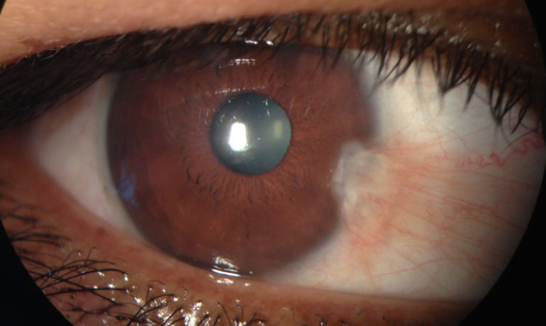 Tengo una "carnosidad" en mi ojo que crece. ¿Es un tumor maligno?. Sobre el pterigion y tumores