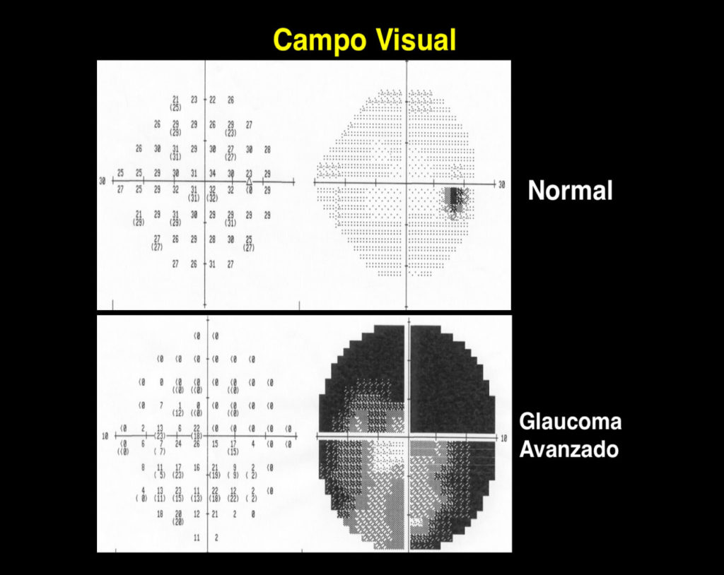 Campo Visual Oncolog A Ocular