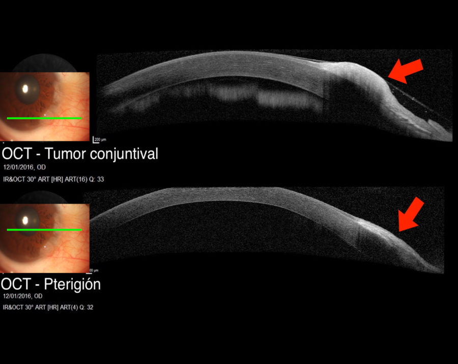 Tumor Epidermoide Conjuntival Oncolog A Ocular